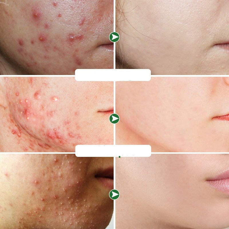 Acne creme facial - Multifunção